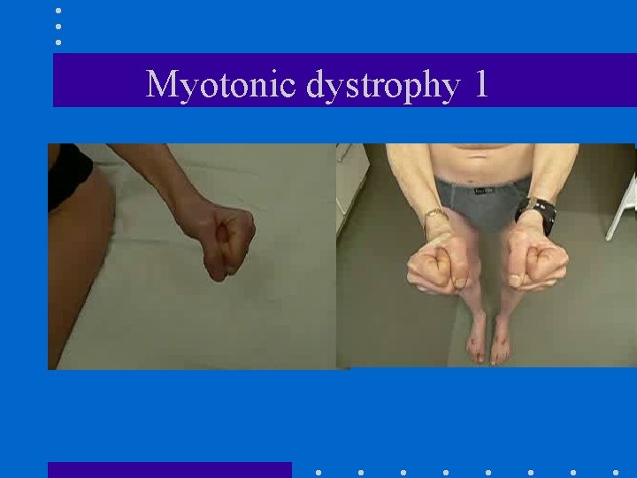 Myotonic dystrophy 1 
