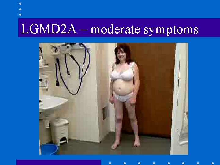 LGMD 2 A – moderate symptoms 