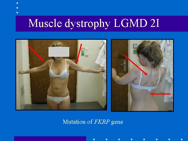 Muscle dystrophy LGMD 2 I Mutation of FKRP gene 