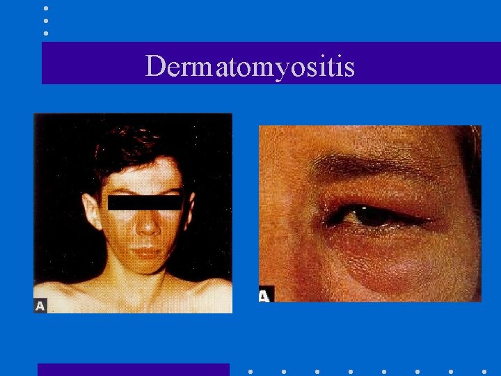 Dermatomyositis 