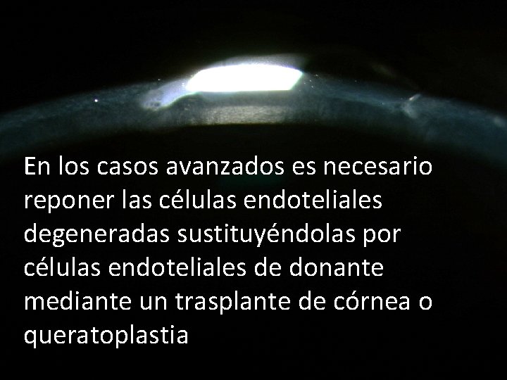 En los casos avanzados es necesario reponer las células endoteliales degeneradas sustituyéndolas por células