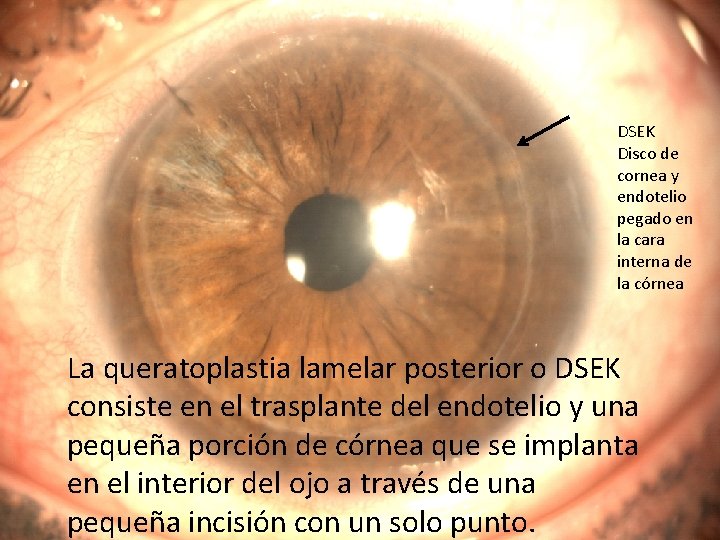 DSEK Disco de cornea y endotelio pegado en la cara interna de la córnea