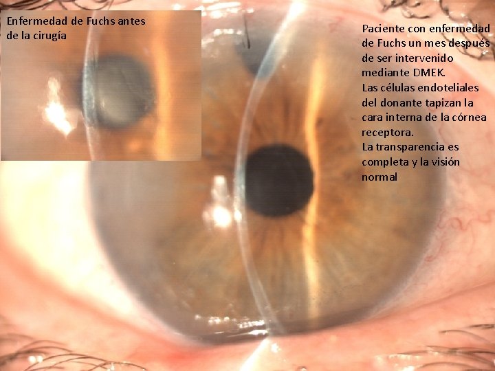 Enfermedad de Fuchs antes de la cirugía Paciente con enfermedad de Fuchs un mes