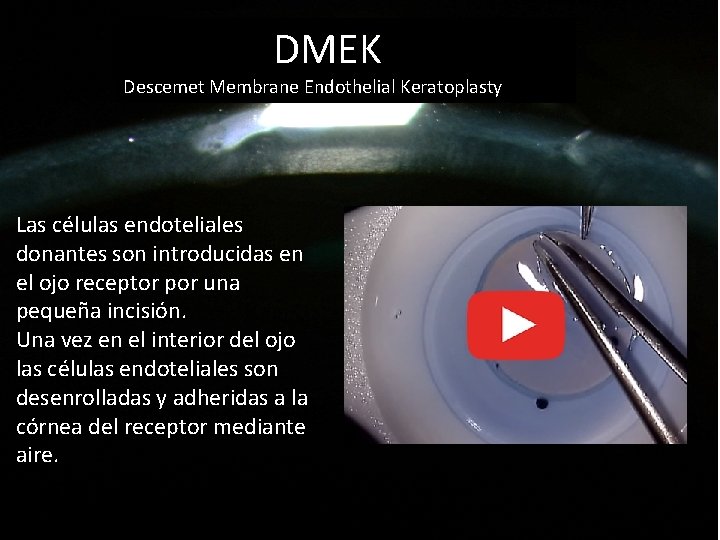 DMEK Descemet Membrane Endothelial Keratoplasty Las células endoteliales donantes son introducidas en el ojo