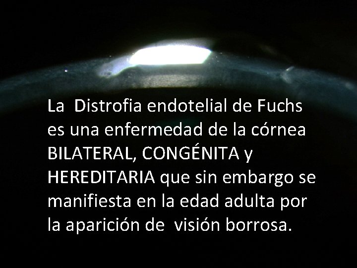 La Distrofia endotelial de Fuchs es una enfermedad de la córnea BILATERAL, CONGÉNITA y