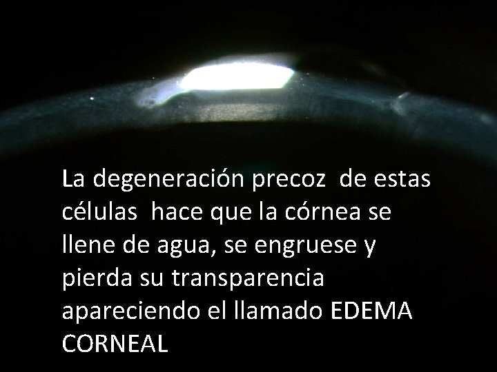 La degeneración precoz de estas células hace que la córnea se llene de agua,