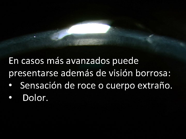 En casos más avanzados puede presentarse además de visión borrosa: • Sensación de roce