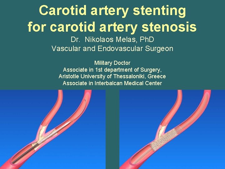 Carotid artery stenting for carotid artery stenosis Dr. Nikolaos Melas, Ph. D Vascular and