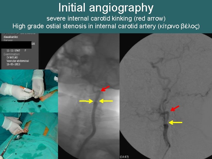 Initial angiography severe internal carotid kinking (red arrow) High grade ostial stenosis in internal