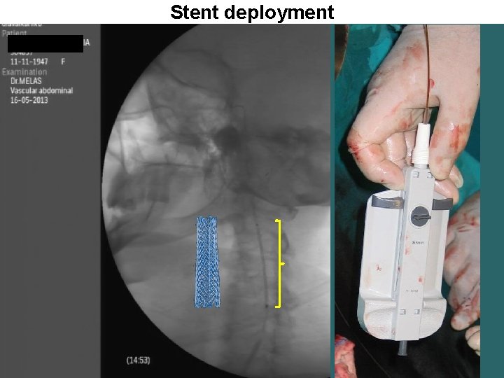 Stent deployment 