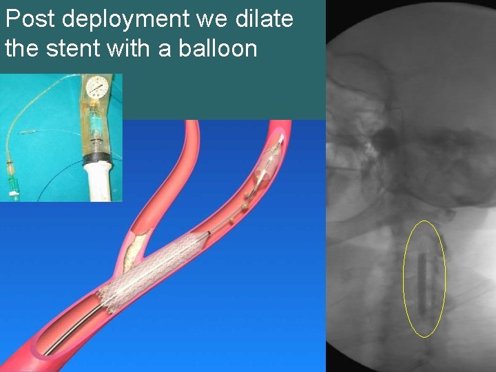 Post deployment we dilate the stent with a balloon 