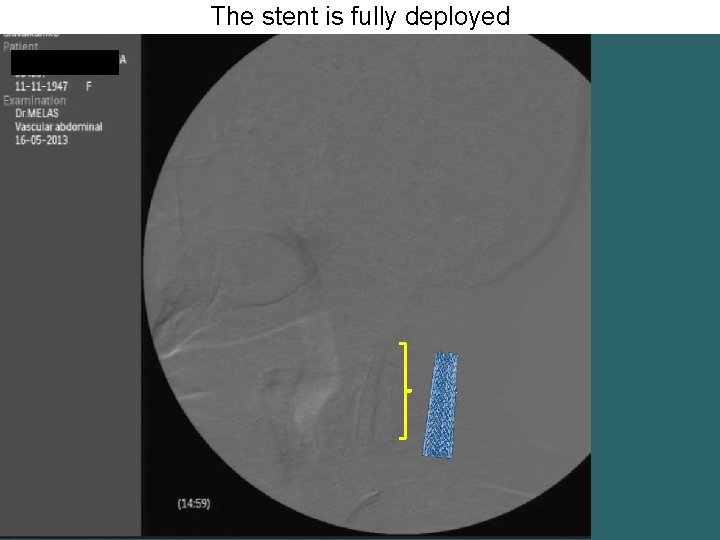 The stent is fully deployed 