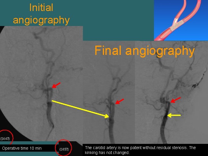 Initial angiography Final angiography Operative time 10 min The carotid artery is now patent