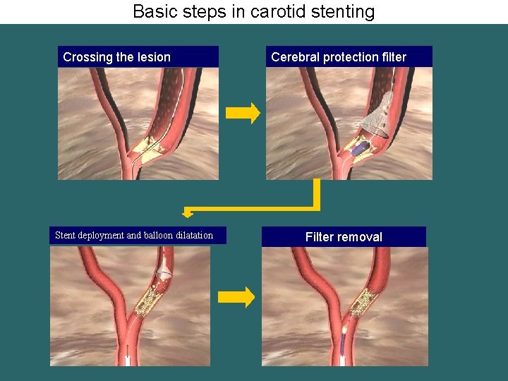 Basic steps in carotid stenting Crossing the lesion Stent deployment and balloon dilatation Cerebral