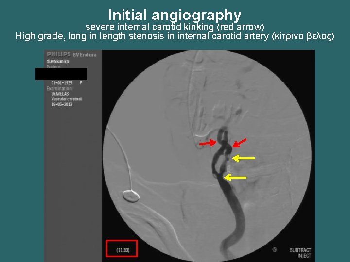 Initial angiography severe internal carotid kinking (red arrow) High grade, long in length stenosis