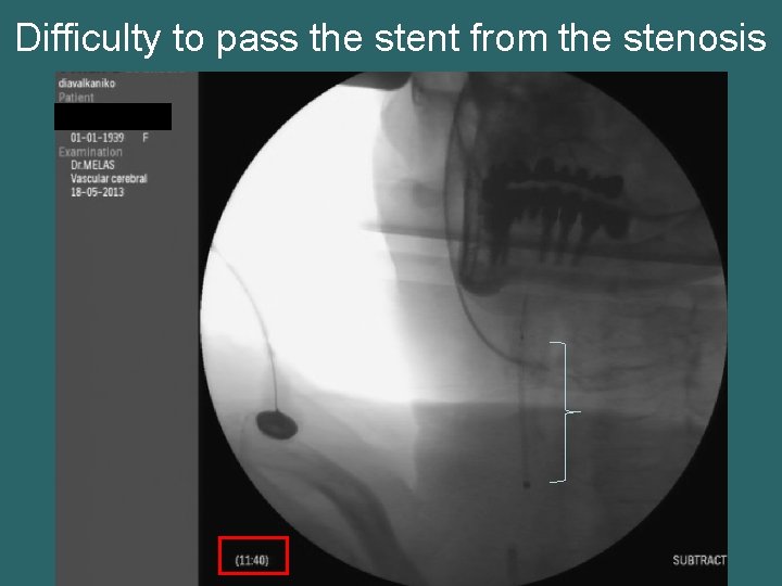 Difficulty to pass the stent from the stenosis 