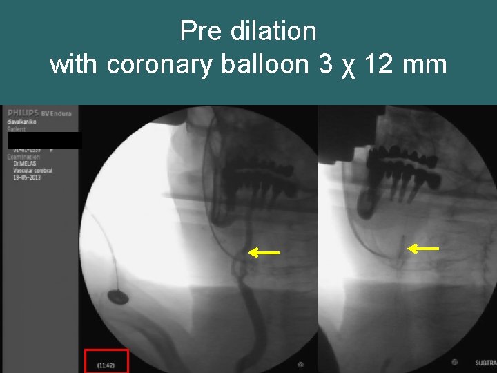 Pre dilation with coronary balloon 3 χ 12 mm 