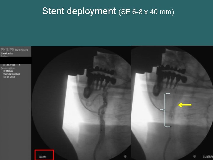 Stent deployment (SE 6 -8 x 40 mm) 