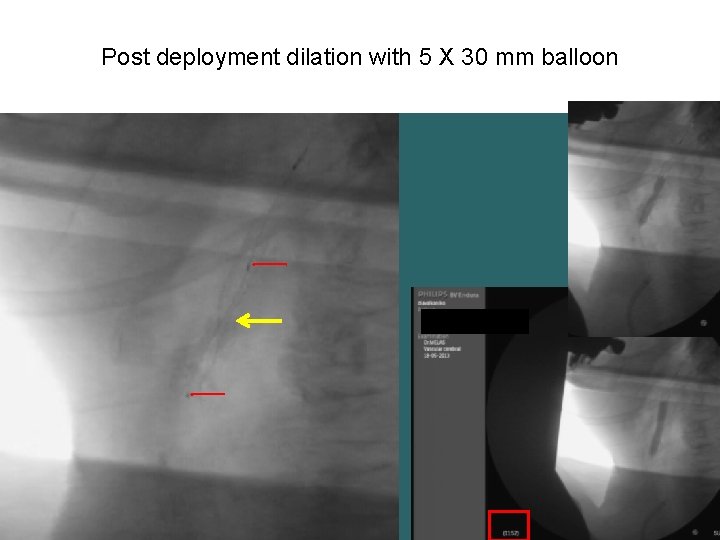 Post deployment dilation with 5 Χ 30 mm balloon 