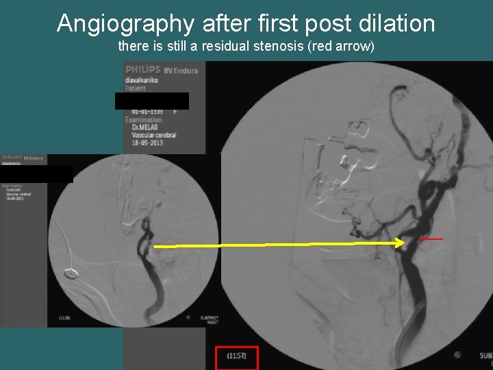 Angiography after first post dilation there is still a residual stenosis (red arrow) 