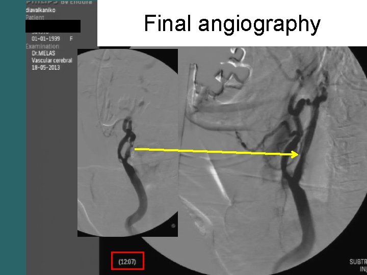 Final angiography 