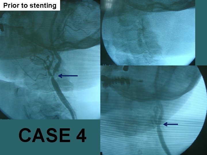 Prior to stenting CASE 4 