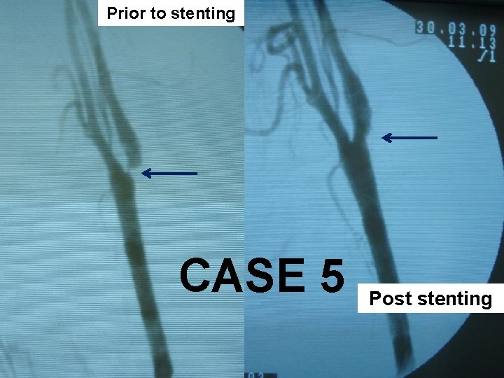 Prior to stenting CASE 5 Post stenting 