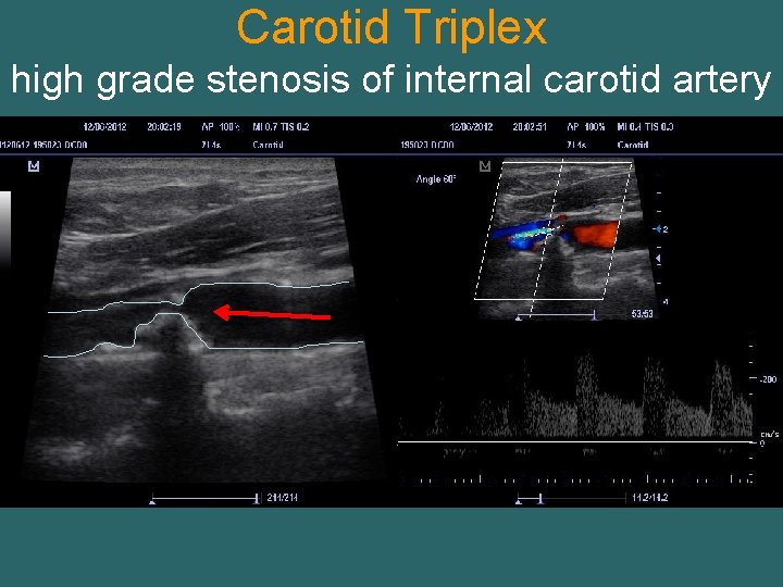 Carotid Triplex high grade stenosis of internal carotid artery 