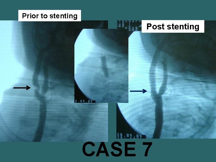 Prior to stenting Post stenting CASE 7 