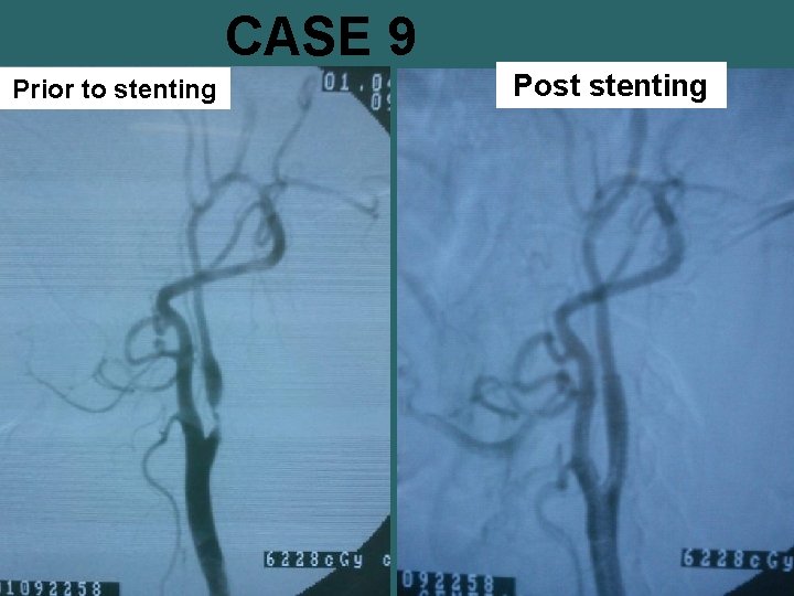 CASE 9 Prior to stenting Post stenting 