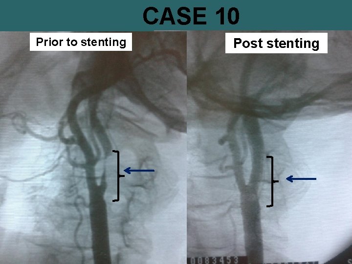 CASE 10 Prior to stenting Post stenting 