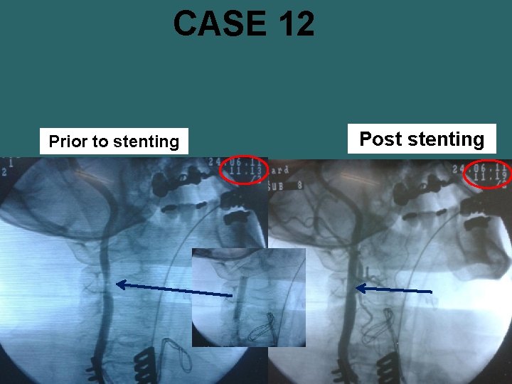 CASE 12 Prior to stenting Post stenting 