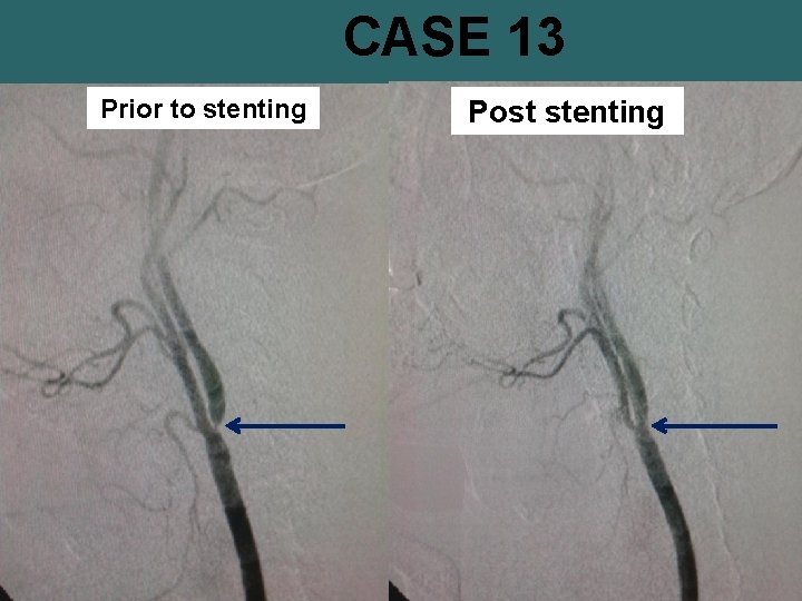 CASE 13 Prior to stenting Post stenting 