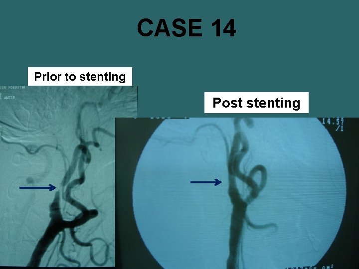 CASE 14 Prior to stenting Post stenting 