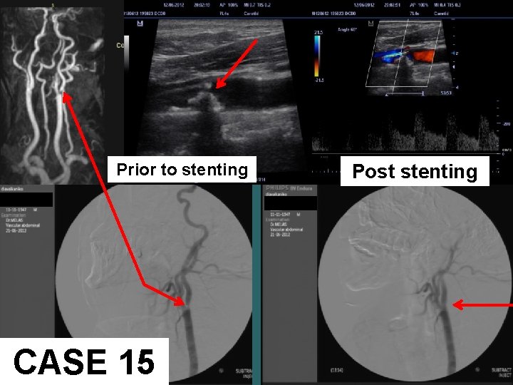 Prior to stenting CASE 15 Post stenting 