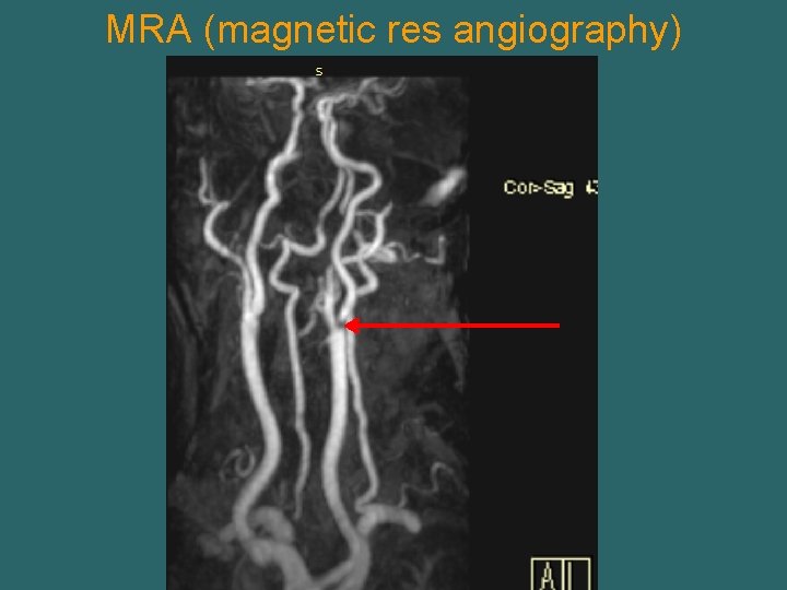 MRA (magnetic res angiography) 