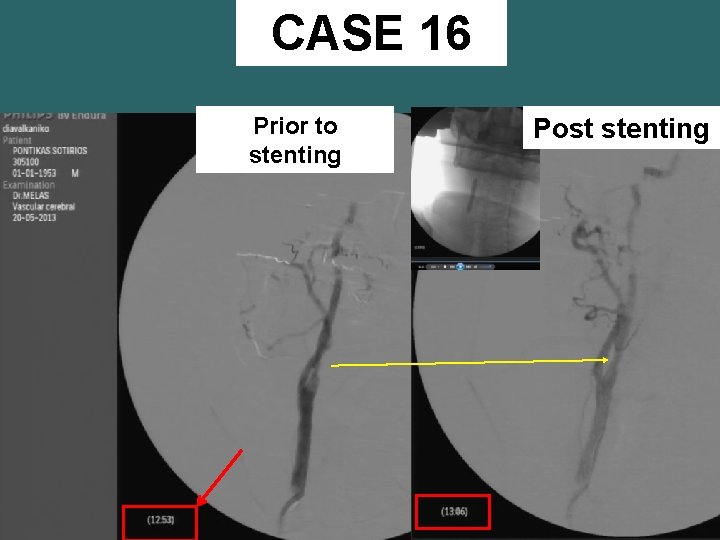 CASE 16 Prior to stenting Post stenting 