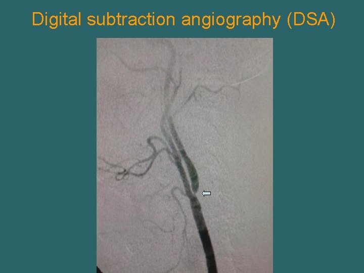 Digital subtraction angiography (DSA) 