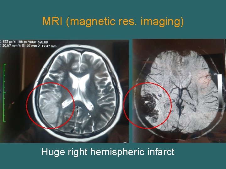 MRI (magnetic res. imaging) Huge right hemispheric infarct 