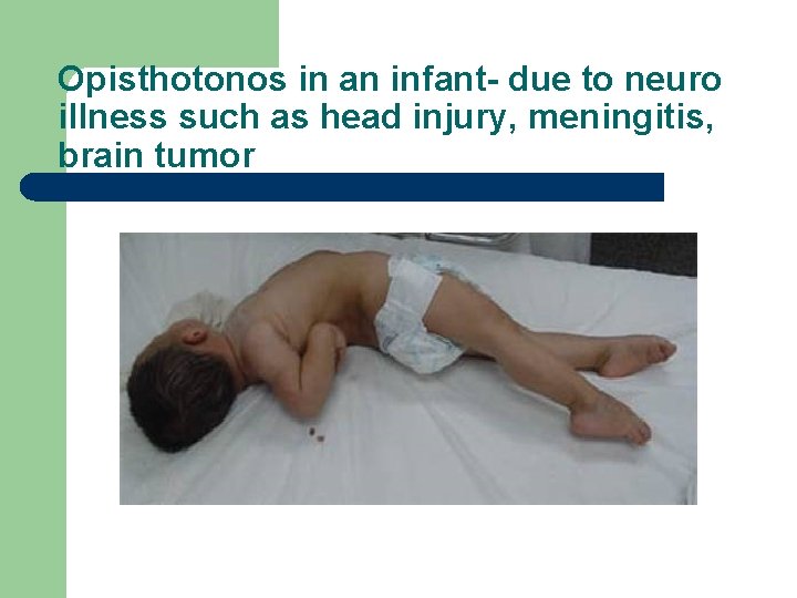 Opisthotonos in an infant- due to neuro illness such as head injury, meningitis, brain
