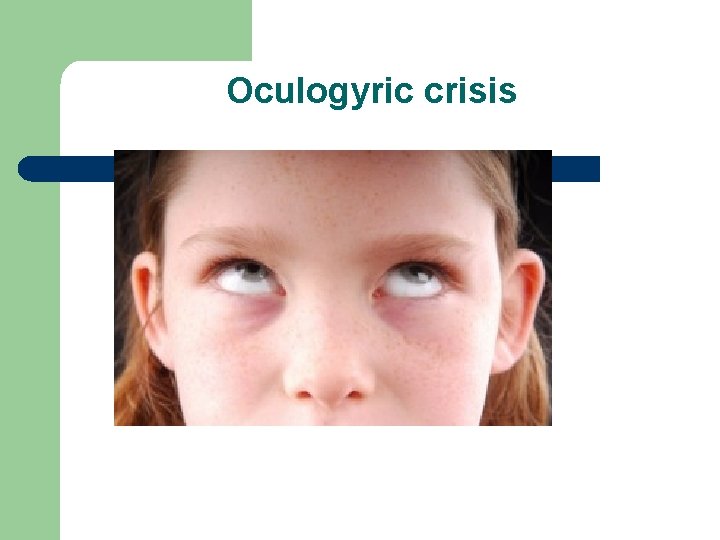 Oculogyric crisis 