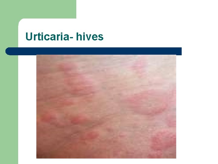 Urticaria- hives 