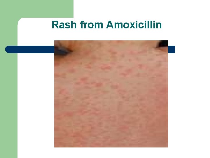 Rash from Amoxicillin 