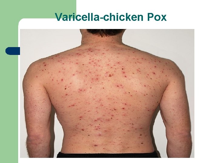 Varicella-chicken Pox 