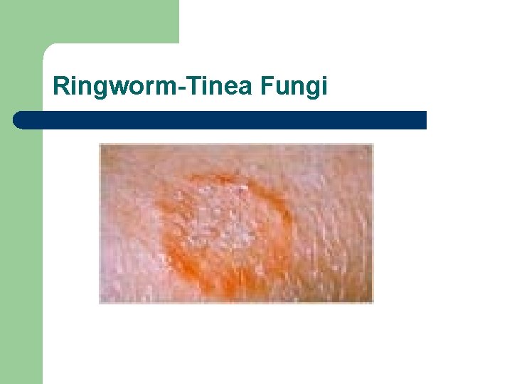Ringworm-Tinea Fungi 