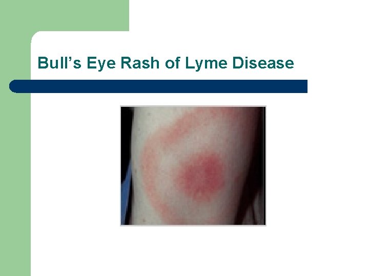 Bull’s Eye Rash of Lyme Disease 