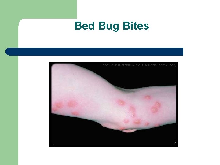 Bed Bug Bites 