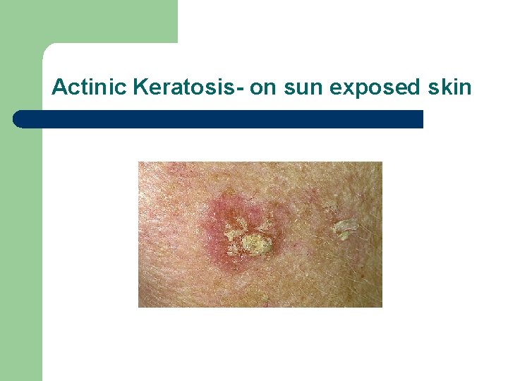 Actinic Keratosis- on sun exposed skin 