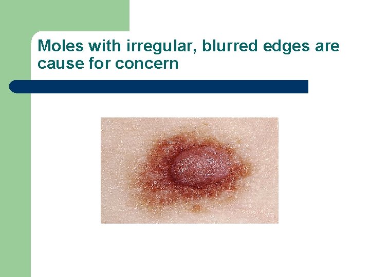 Moles with irregular, blurred edges are cause for concern 
