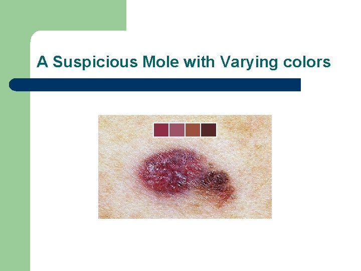 A Suspicious Mole with Varying colors 